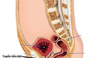 Chế độ sinh hoạt  hợp lý  để điều trị phì đại lành tính tuyến tiền liệt