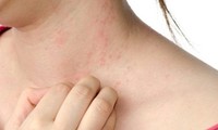 Công dụng của sản phẩm giải độc gan boganic phòng ngừa di ứng