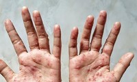 Health Ministry recommends measures to prevent monkeypox