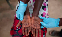 Africa CDC declares monkey pox a public health emergency