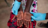 WHO declares mpox a global public health emergency for second time in two years