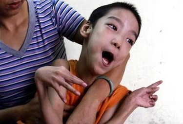 Ein besseres Leben für kleine Agent-Orange-Opfer