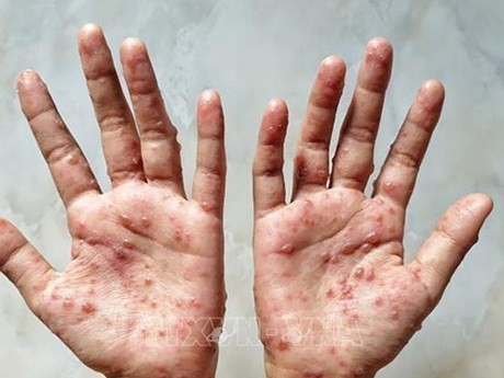 Health Ministry recommends measures to prevent monkeypox