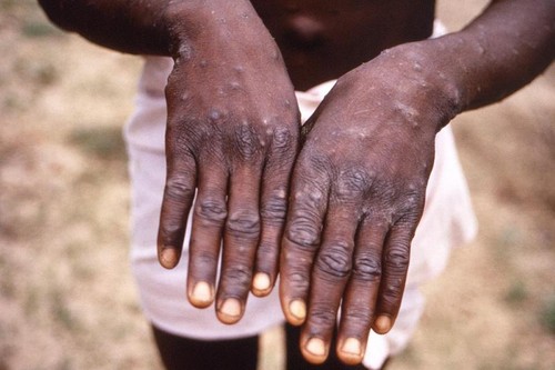 Monkeypox sera renommé mpox pour éviter la stigmatisation, annonce l’OMS - ảnh 1