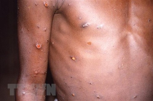 WHO holds emergency meeting on monkeypox - ảnh 1