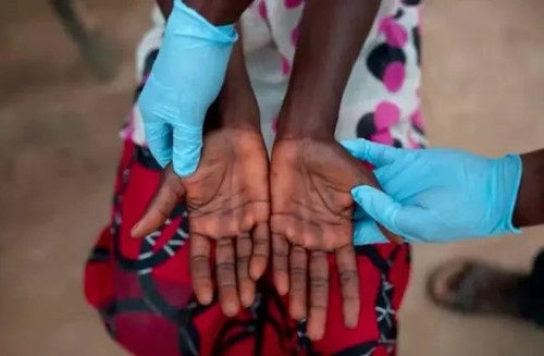 WHO declares mpox a global public health emergency for second time in two years - ảnh 1